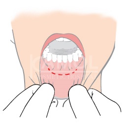 แบบมีแผลภายในปาก