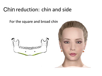 Riduzione del mento mediante resezione dell'osso dall'angolo del mento al centro della mandibola