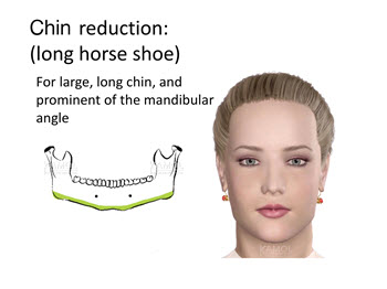 Riduzione del mento mediante resezione da un lato all'altro della mascella angolare attraverso la mandibola e il mento, come riduzione 