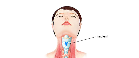 Adam’s apple Surgery (Thyroid Cartilage Enhancement)