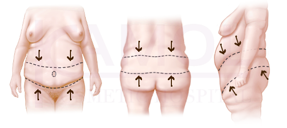 Positioning of body lift incision