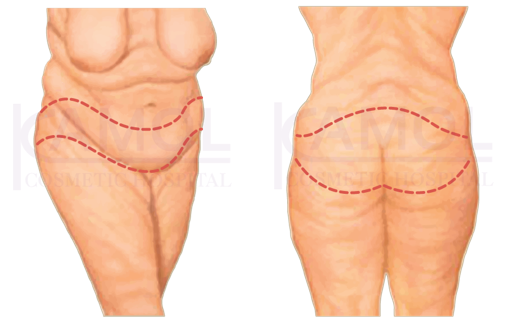 Shows the incision line for belt lipectomy or truncal body.