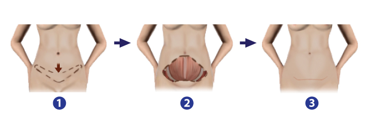 Shows Surgical Procedures of Mini Abdominoplasty.