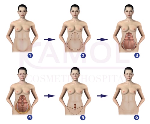 Surgical Procedures of Abdominoplasty (Tummy Tuck) with umbilical transposition and repairing the sagging abdominal muscles: