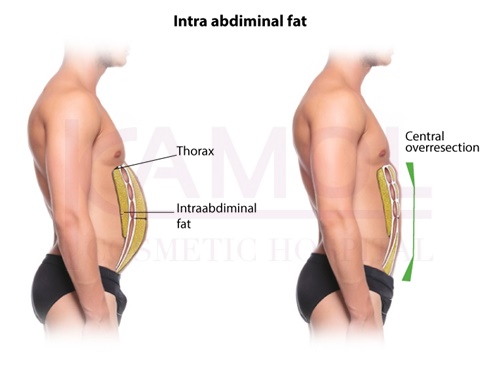 shows the area of excess fat above and below the abdominal cavity and six-pack creation 