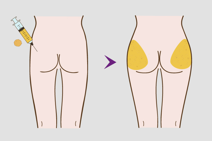 แสดงการ ผ่าตัดเสริมสะโพกด้วยการฉีดไขมัน (Fat Graft )