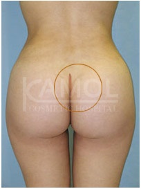 Buttocks augmentation incision and implants