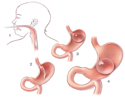 Shows Gastric Balloon procedures 