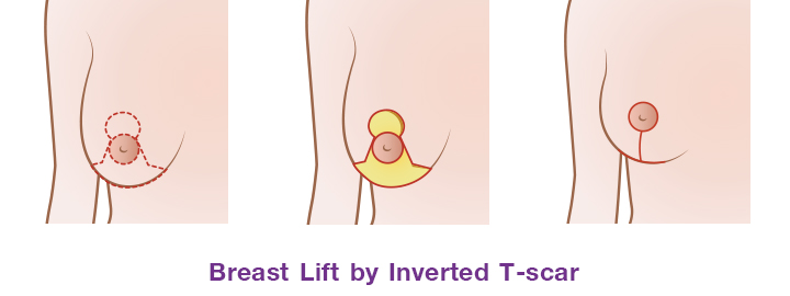 The incision around areolar, vertical down from the areolar to breast crease and horizontally along the breast crease. ( Inverted T -Scar)