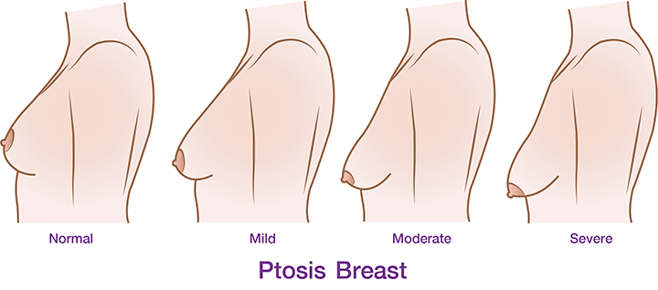 degree of ptosis