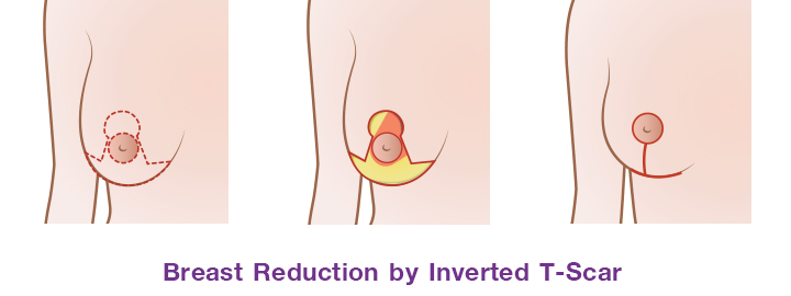 แสดงการผ่าตัดลดขนาดหน้าอกแบบแผลตัว T กลับด้าน