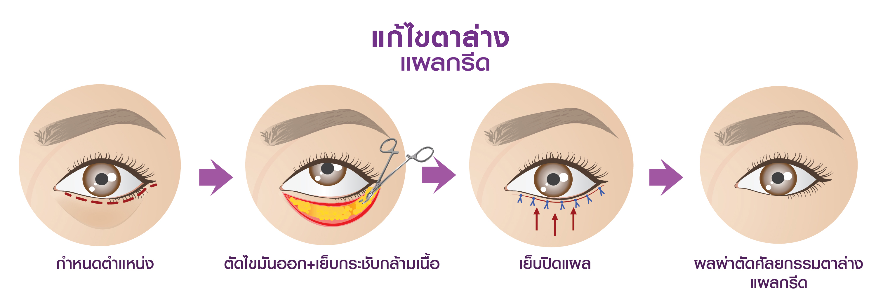 แสดงขั้นตอนการทำ ศัลยกรรมตาล่าง แผลกรีด