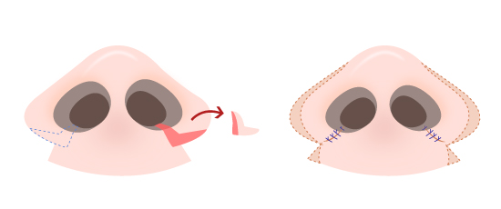 Shows before and after rhinoplasty by alarplasty